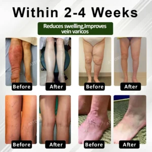 ATTDX® ChestnutEase Edema Massage Herbal Cream