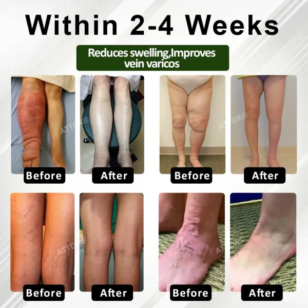 ATTDX® ChestnutEase Edema Massage Herbal Cream