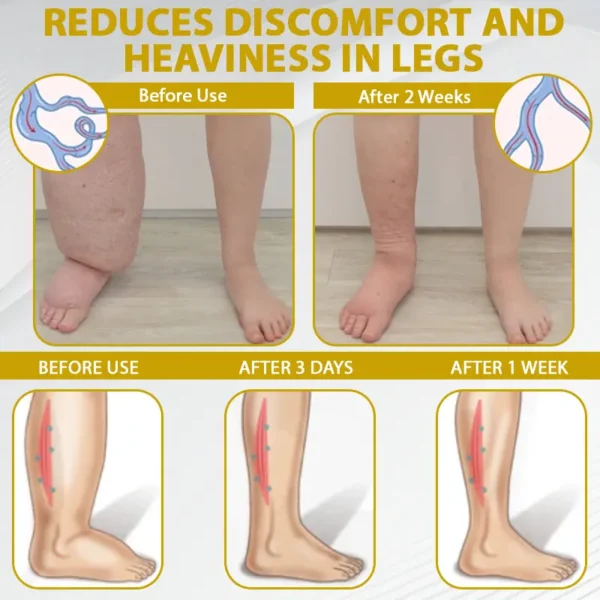 ATTDX® ApisChestnut Herbal Edema Relief Cream