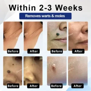 ATTDX® DermaSoft Tag & Mole Clear Gel