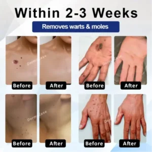 ATTDX® DermaSoft Tag & Mole Clear Gel