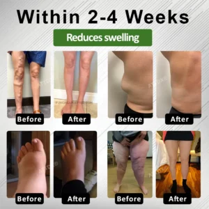 ATTDX® LegLight Edema Therapy Cream