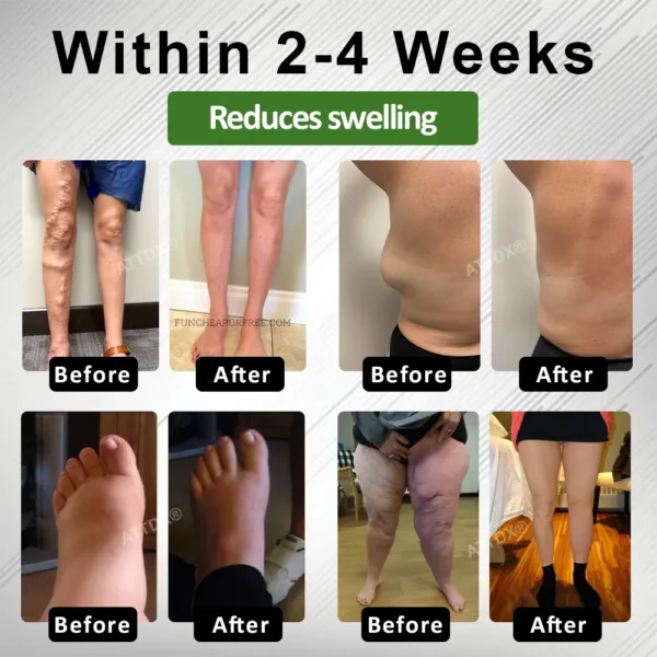 ATTDX® LegLight Edema Therapy Cream