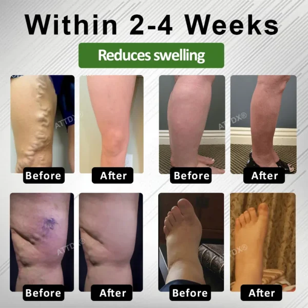 ATTDX® LegLight Edema Therapy Cream