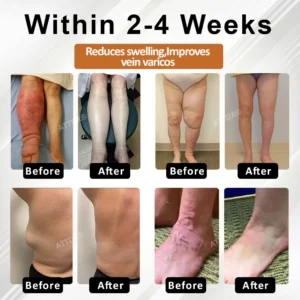 ATTDX® ManukaRelief Edema Therapy Cream