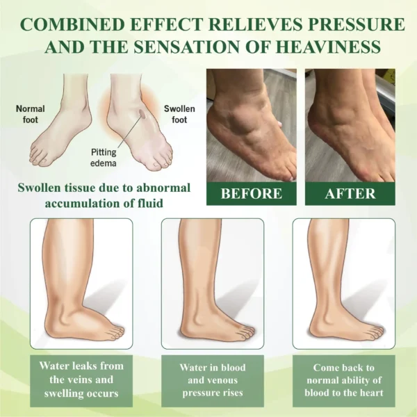 ATTDX® PuffyGone Horse Chestnut Edema Cream