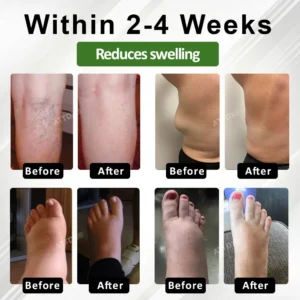 ATTDX® SpiculeFlow Advanced Edema Drainage Cream
