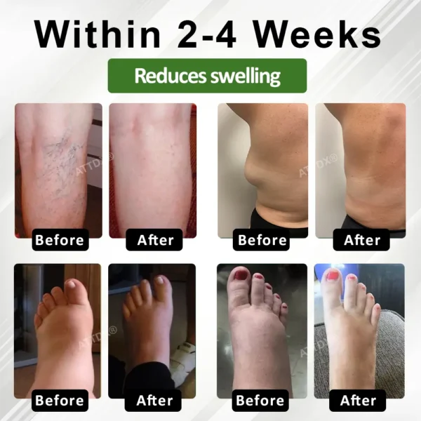 ATTDX® SpiculeFlow Advanced Edema Drainage Cream