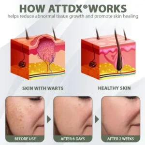ATTDX® Tea Tree Focused WartAway MicroDart Patch