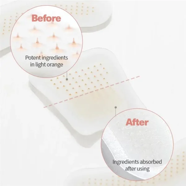 ATTDX® MicroSting Bee Vein Ease Patches
