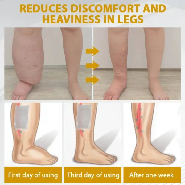 ATTDX® MicroSting Bee Vein Ease Patches