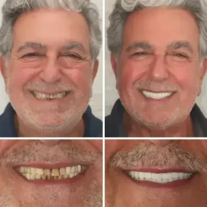 【Official Brand Store】Custom-Fit Functional Dentures — ComfortMax Edition